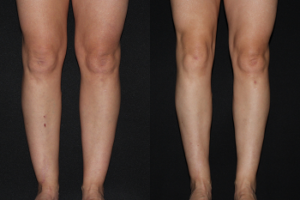 45 yo before and 5 months after Liposculpture of Thighs, Medial Knees, Calves and Ankles.