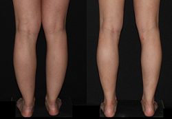 30 year old before and one year after Liposuction of Medial knees, Calves and Ankles.