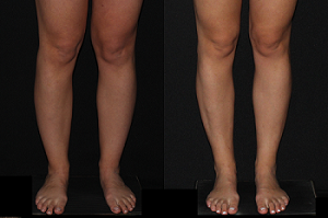 30 year old before and one year after Liposuction of Medial knees, Calves and Ankles.