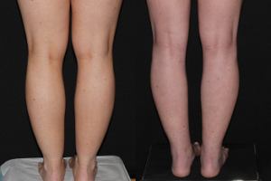 Thigh, Knee, Calf & Ankle Liposuction. 27 yo before and 6 weeks after Liposuction of Thighs, Medial Knees, Calves and Ankles.