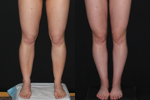 Thigh, Knee, Calf & Ankle Liposuction. 27 yo before and 6 weeks after Liposuction of Thighs, Medial Knees, Calves and Ankles.