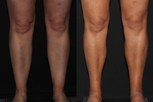 50 year old before and 4 months after Liposuction of Medial knees, Calves and Ankles.