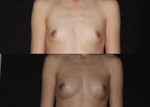 Breast augmentation with fat transfer. 30-year-old patient before and 4 months after natural breast augmentation transferring patient's own fat to enlarge breasts.