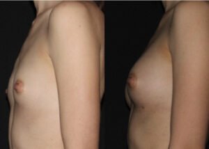 Breast augmentation with fat transfer. 30-year-old patient before and 4 months after natural breast augmentation transferring patient's own fat to enlarge breasts.