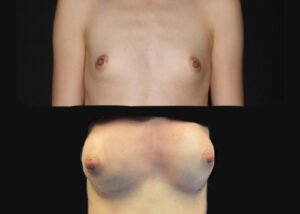 Breast augmentation with fat transfer. Before and during natural breast augmentation transferring patient's own fat to enlarge breasts.