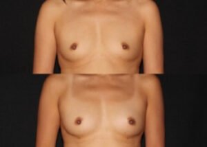 Breast augmentation with fat transfer. Before and 4 weeks after fat grafting from abdomen to breast.