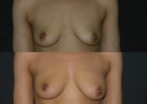 Breast augmentation. 28-year-old patient before and after fat grafting  to breast.