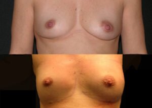 Breast augmentation. 43-year-old patient before and after fat grafting to breast.