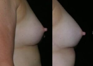 Implant removal/Breast augmentation with fat grafting. 55-year-old patient before and after implant removal and fat grafting breast augmentation, with fat taken from the abdomen.