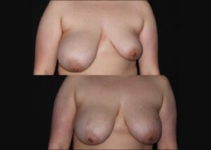 Breast liposuction and augmentation using fat transfer. Young patient with marked breast asymmetry before and 18 months after staged right breast liposuction and fat grafting to left breast and Thermage for skin lightening.