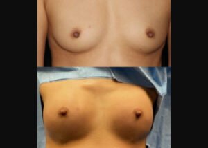 Breast Augmentation with fat transfer. Before and during natural  breast augmentation transferring the patient's own fat from abdomen, love handles and hips to breasts.