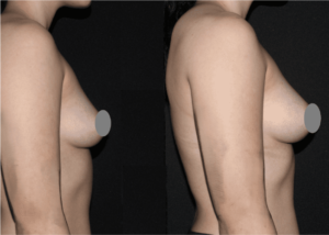 22-year-old woman patient 3 months following fat transfer from hips and abdomen to both breasts